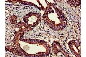 Immunohistochemistry of paraffin-embedded human colon cancer using ABIN7147780 at dilution of 1:100
