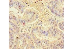 Immunohistochemistry of paraffin-embedded human colon cancer using ABIN7157538 at dilution of 1:100 (KLRG1 anticorps  (AA 60-195))
