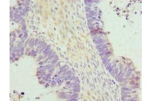 Immunohistochemistry of paraffin-embedded human ovarian cancer using ABIN7155889 at dilution of 1:100 (HERPUD1 anticorps  (AA 1-240))