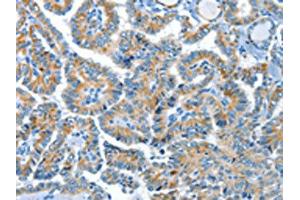 The image on the left is immunohistochemistry of paraffin-embedded Human thyroid cancer tissue using ABIN7190321(COG1 Antibody) at dilution 1/60, on the right is treated with synthetic peptide. (COG1 anticorps)