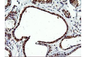 Immunohistochemical staining of paraffin-embedded Human breast tissue using anti-EPM2AIP1 mouse monoclonal antibody.