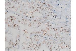 ABIN6267377 at 1/200 staining Human liver cancer tissue sections by IHC-P.