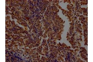 IHC image of ABIN7127651 diluted at 1:100 and staining in paraffin-embedded human lung cancer performed on a Leica BondTM system.