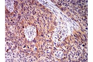 Immunohistochemical analysis of paraffin-embedded cervical cancer tissues using BIN1 mouse mAb with DAB staining.