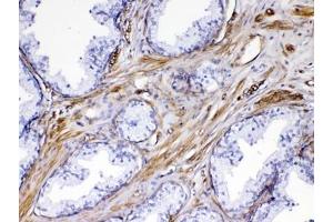 IHC testing of FFPE human prostate cancer tissue with VEGF Receptor 3 antibody at 1ug/ml. (FLT4 anticorps)