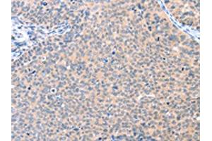 The image on the left is immunohistochemistry of paraffin-embedded Human cervical cancer tissue using ABIN7128109(AADACL2 Antibody) at dilution 1/25, on the right is treated with fusion protein. (AADACL2 anticorps)