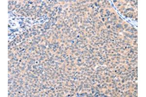 The image on the left is immunohistochemistry of paraffin-embedded Human cervical cancer tissue using ABIN7128109(AADACL2 Antibody) at dilution 1/25, on the right is treated with fusion protein.