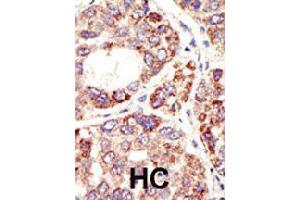 Formalin-fixed and paraffin-embedded human hepatocellular carcinoma tissue reacted with MDM2 polyclonal antibody  , which was peroxidase-conjugated to the secondary antibody, followed by DAB staining. (MDM2 anticorps  (C-Term))