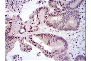Immunohistochemical analysis of paraffin-embedded colon cancer tissues using FOS mouse mAb with DAB staining. (c-FOS anticorps)