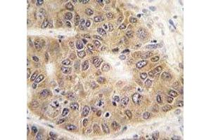 IHC analysis of FFPE human hepatocarcinoma tissue stained with SUMO4 antibody