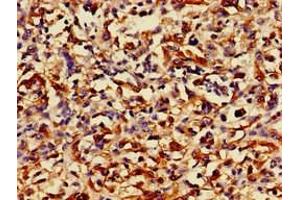 Immunohistochemistry of paraffin-embedded human melanoma using ABIN7168489 at dilution of 1:100