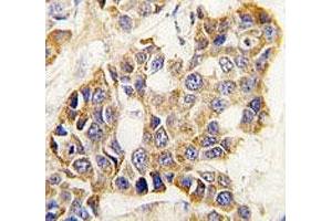 IHC analysis of FFPE human breast carcinoma tissue stained with MMP9 antibody