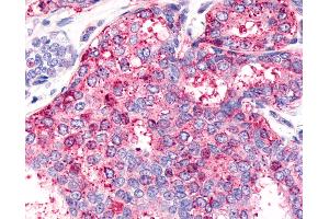 Anti-HNF4G / HNF4 Gamma antibody IHC of human Breast, Carcinoma.