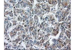 Immunohistochemical staining of paraffin-embedded Carcinoma of liver tissue using anti-BSG mouse monoclonal antibody. (CD147 anticorps)
