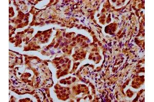 IHC image of ABIN7172685 diluted at 1:500 and staining in paraffin-embedded human lung cancer performed on a Leica BondTM system.