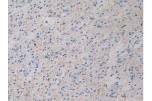 DAB staining on IHC-P; Samples: Human Glioma Tissue. (GHRH anticorps  (AA 19-108))