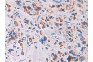DAB staining on IHC-P; Samples: Human Stomach cancer Tissue (RNASE12 anticorps  (AA 21-147))