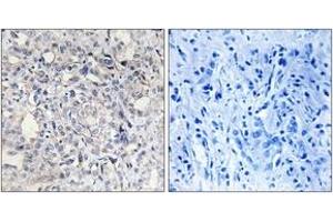 Immunohistochemistry analysis of paraffin-embedded human liver carcinoma tissue, using Heparin Cofactor II Antibody. (SERPIND1 anticorps  (AA 41-90))