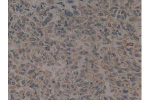 DAB staining on IHC-P; Samples: Human Liver cancer Tissue