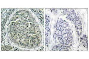 Immunohistochemical analysis of paraffin-embedded human breast carcinoma tissue using b-Catenin(Phospho-Ser37) Antibody(left) or the same antibody preincubated with blocking peptide(right).