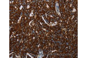 Immunohistochemistry of Human esophagus cancer using KISS1R Polyclonal Antibody at dilution of 1:30 (KISS1R anticorps)