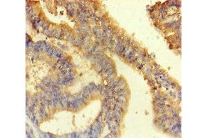 Immunohistochemistry of paraffin-embedded human endometrial cancer using ABIN7144171 at dilution of 1:100