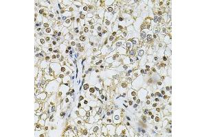 Immunohistochemistry of paraffin-embedded human kidney cancer using IFI16 Antibody (ABIN6129036, ABIN6142162, ABIN6142163 and ABIN6218202) at dilution of 1:100 (40x lens). (IFI16 anticorps  (AA 1-300))