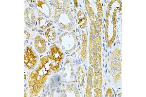 Immunohistochemistry of paraffin-embedded human kidney cancer using TNFRSF11B Antibody (ABIN3022914, ABIN3022915, ABIN3022916 and ABIN6219293) at dilution of 1:200 (40x lens).
