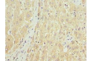Immunohistochemistry of paraffin-embedded human liver tissue using ABIN7155892 at dilution of 1:100 (HGD anticorps  (AA 226-445))