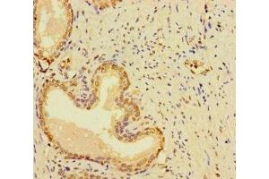 Immunohistochemistry of paraffin-embedded human prostate cancer using ABIN7166969 at dilution of 1:100 (RABEP2 anticorps  (AA 301-533))