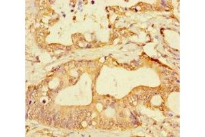 Immunohistochemistry of paraffin-embedded human colon cancer using ABIN7153335 at dilution of 1:100