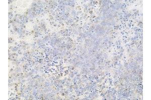 ABIN6256556 and ABIN6267493 at 1/100 staining human melanoma by IHC-P. (MEK2 anticorps  (pThr394))
