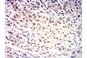 Immunohistochemical analysis of paraffin-embedded esophageal cancer tissues using HTRA2 mouse mAb with DAB staining.