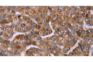 Immunohistochemistry of paraffin-embedded Human liver cancer tissue using HSP10 Polyclonal Antibody at dilution 1:40 (HSPE1 anticorps)