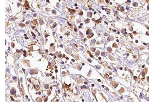 ABIN6279152 at 1/100 staining Human breast cancer tissue by IHC-P. (ATP5E anticorps  (Internal Region))