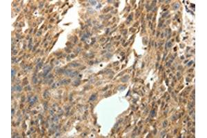The image on the left is immunohistochemistry of paraffin-embedded Human ovarian cancer tissue using ABIN7131276(SYT7 Antibody) at dilution 1/15, on the right is treated with fusion protein. (SYT7 anticorps)