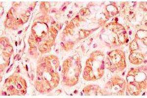 Human stomach cancer tissue was stained by rabbit Anti-Spexin prepro (73-116)  (H) Antibody (Spexin anticorps  (Preproprotein))