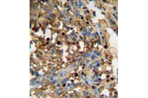 Formalin fixed and paraffin embedded human breast carcinoma  reacted WITH DMP4 Antibody (C-term) followed by peroxidase conjugation of the secondary antibody and DAB staining. (FAM20C anticorps  (C-Term))