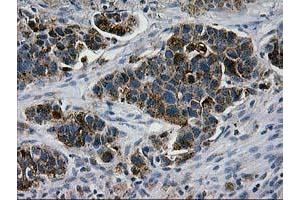 Immunohistochemical staining of paraffin-embedded Carcinoma of Human lung tissue using anti-LGALS3BP mouse monoclonal antibody. (LGALS3BP anticorps  (AA 19-300))