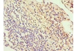 Immunohistochemistry of paraffin-embedded human cervical cancer using ABIN7170114 at dilution of 1:100 (GLUT1 anticorps  (AA 210-310))