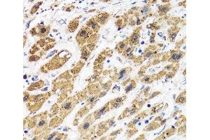 Immunohistochemistry of paraffin-embedded Human liver cancer using HAPLN1 Polyclonal Antibody at dilution of 1:100 (40x lens). (HAPLN1 anticorps)