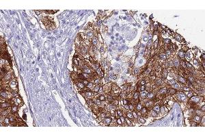 ABIN6276794 at 1/100 staining Human urothelial cancer tissue by IHC-P.