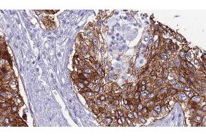 ABIN6276794 at 1/100 staining Human urothelial cancer tissue by IHC-P. (CD46 anticorps  (N-Term))