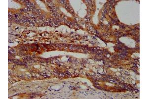 IHC image of ABIN7168210 diluted at 1:400 and staining in paraffin-embedded human colon cancer performed on a Leica BondTM system. (SBDS anticorps  (AA 37-153))