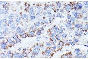 Immunohistochemistry of paraffin-embedded Human liver cancer using CCDC6 Polyclonal Antibody at dilution of 1:100 (40x lens). (CCDC6 anticorps)