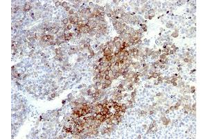 Formalin-fixed, paraffin-embedded human Melanoma stained with NGFR Monoclonal Antibody (NGFR5 + NTR/912). (NGFR anticorps)