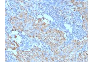 Formalin-fixed, paraffin-embedded human GIST stained with CD117 Mouse Monoclonal Antibody (C117/370). (KIT anticorps)