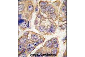 Formalin-fixed and paraffin-embedded human breast carcinoma tissue reacted with CDH13 antibody , which was peroxidase-conjugated to the secondary antibody, followed by DAB staining.