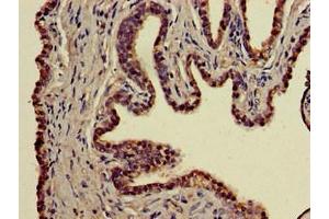 Immunohistochemistry of paraffin-embedded human prostate cancer using ABIN7155629 at dilution of 1:100