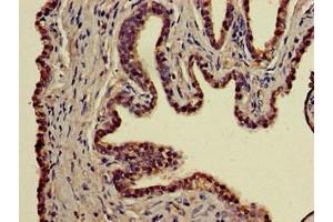 Immunohistochemistry of paraffin-embedded human prostate cancer using ABIN7155629 at dilution of 1:100 (BBX anticorps  (AA 62-292))